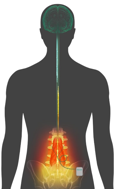 ReActiv8® Implantat in der Lendenwirbelregion